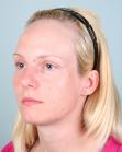 Before Hair Transplant&nbsp;Hairline